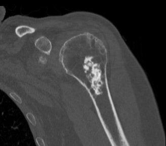 Shoulder Enchondroma CT